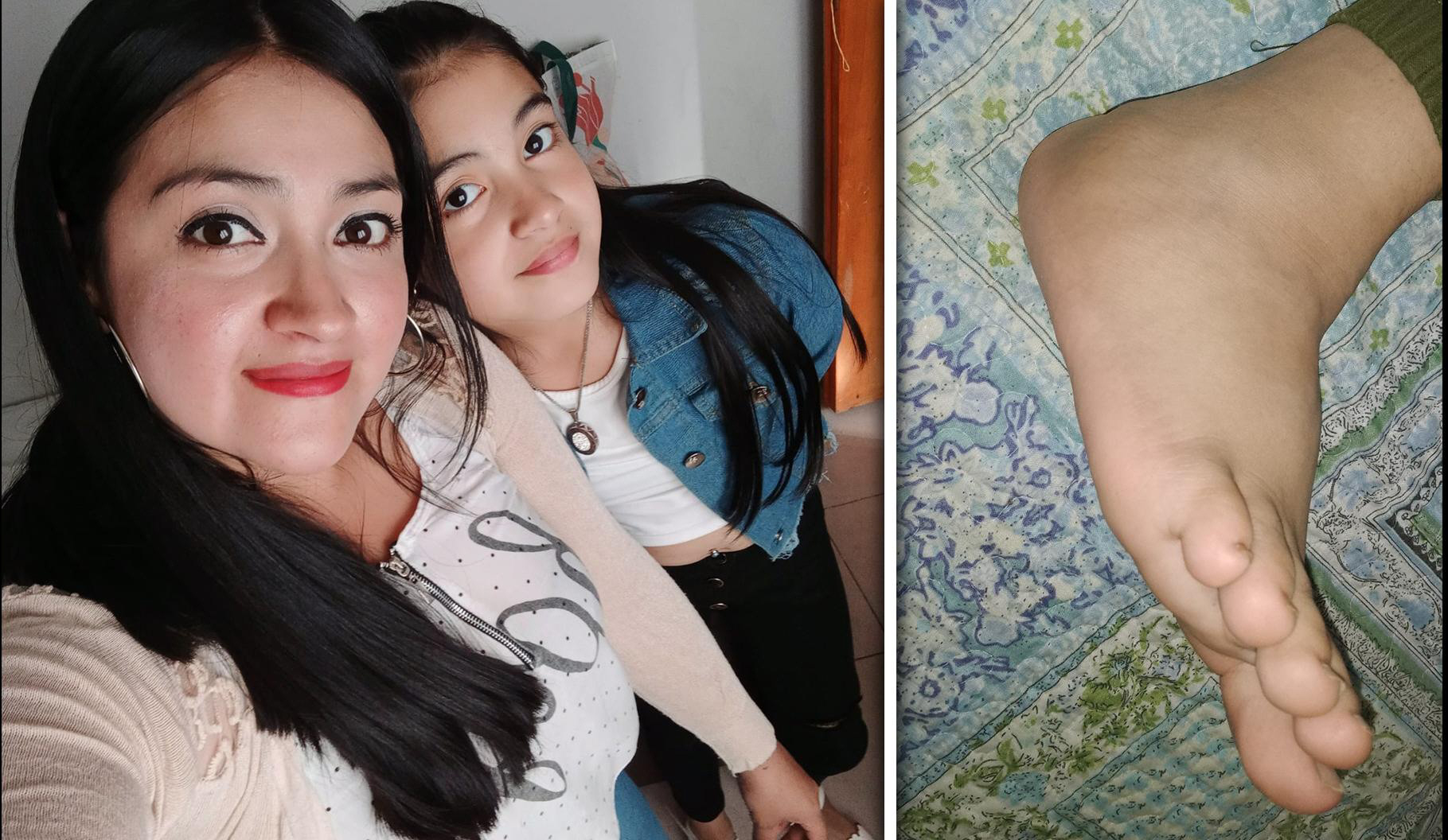 Aimara será operada en Buenos Aires para tratar la trombosis en su pie Aimara será operada en Buenos Aires para tratar la trombosis en su pie