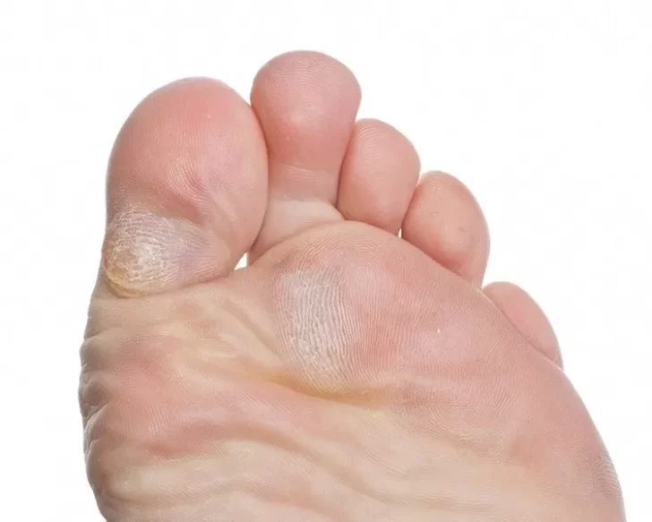 Método casero y efectivo para eliminar los callos de los pies
