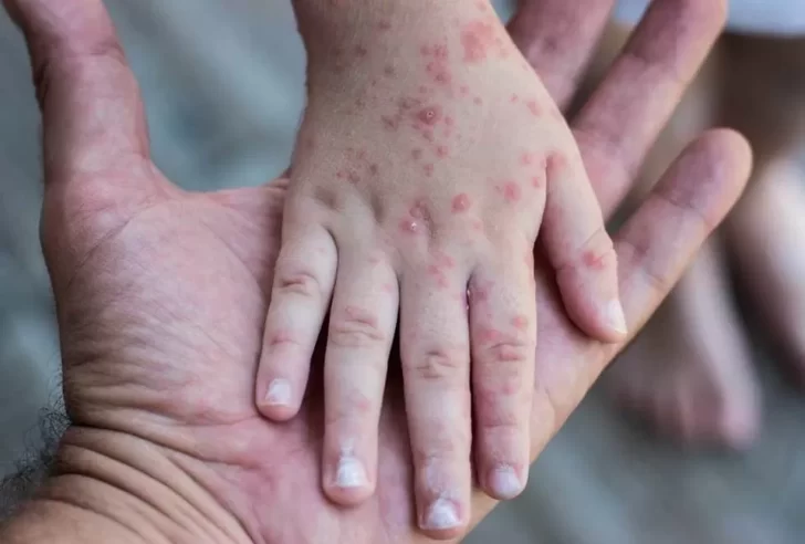 Viruela del mono: cuáles son los síntomas y cómo se contagia esta enfermedad
