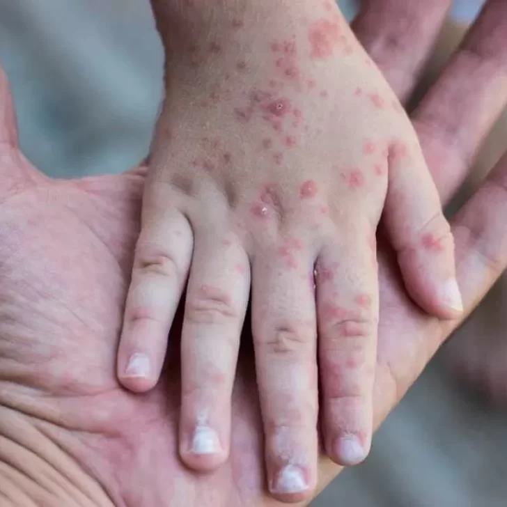 Viruela del mono: cuáles son los síntomas y cómo se contagia esta enfermedad Viruela del mono: cuáles son los síntomas y cómo se contagia esta enfermedad