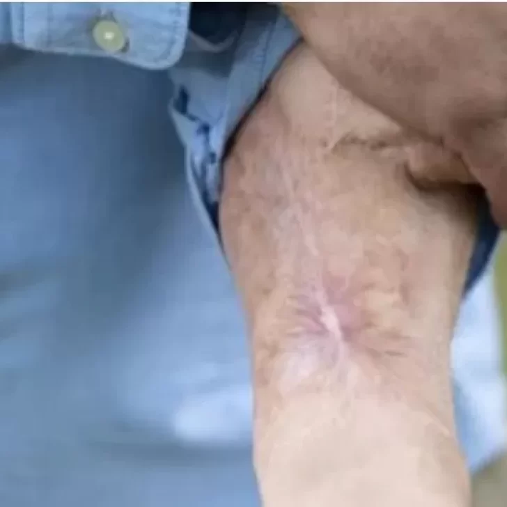 Vivió 6 años con un injerto de su pene en el brazo Vivió 6 años con un injerto de su pene en el brazo