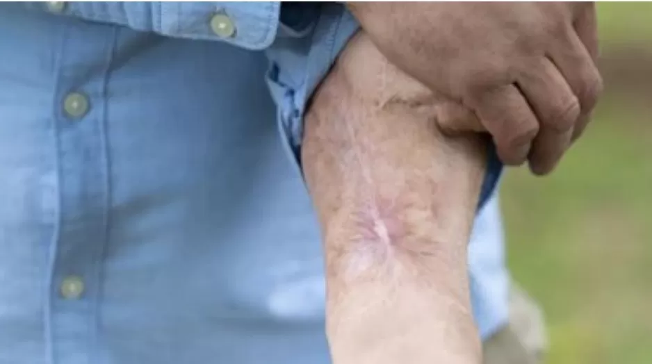 Vivió 6 años con un injerto de su pene en el brazo Vivió 6 años con un injerto de su pene en el brazo