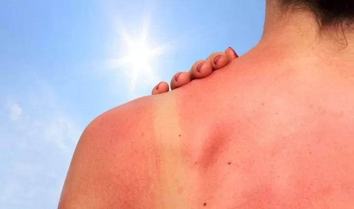 Verano 2022: siete remedios caseros para las quemaduras de sol