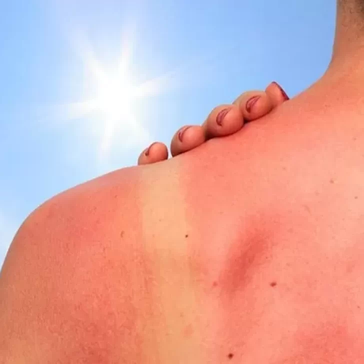 Verano 2022: siete remedios caseros para las quemaduras de sol
