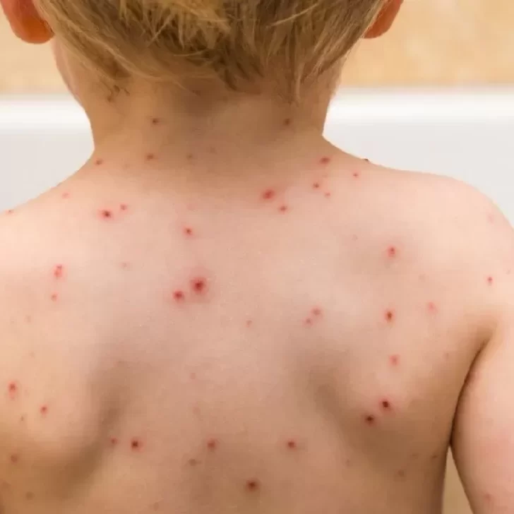 Confirmaron un caso de sarampión en Argentina Confirmaron un caso de sarampión en Argentina