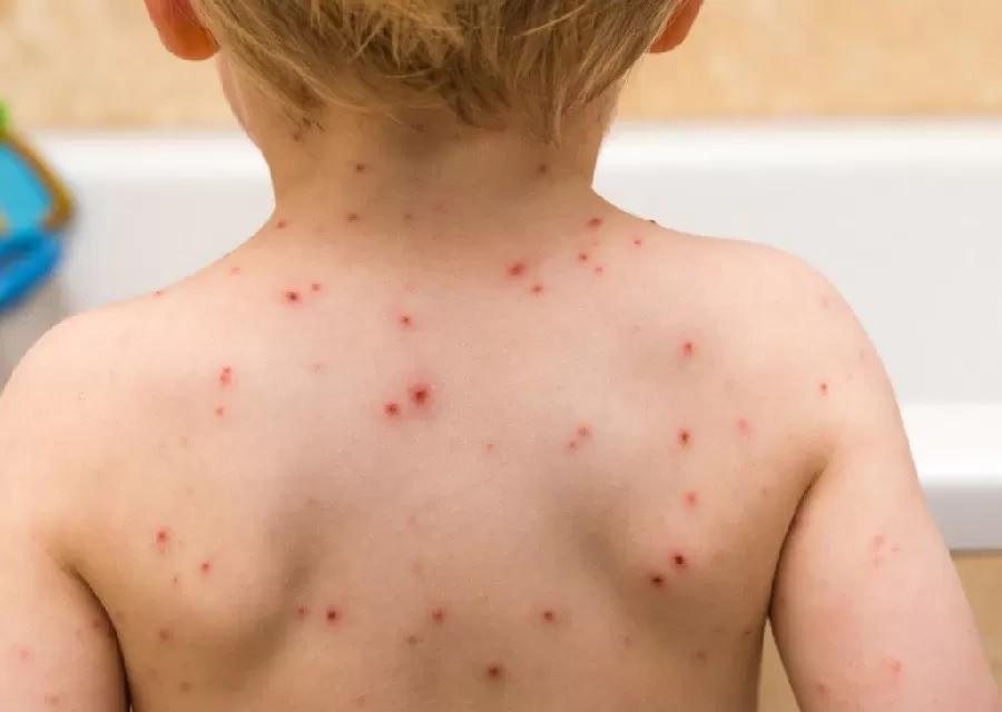 Confirmaron un caso de sarampión en Argentina Confirmaron un caso de sarampión en Argentina