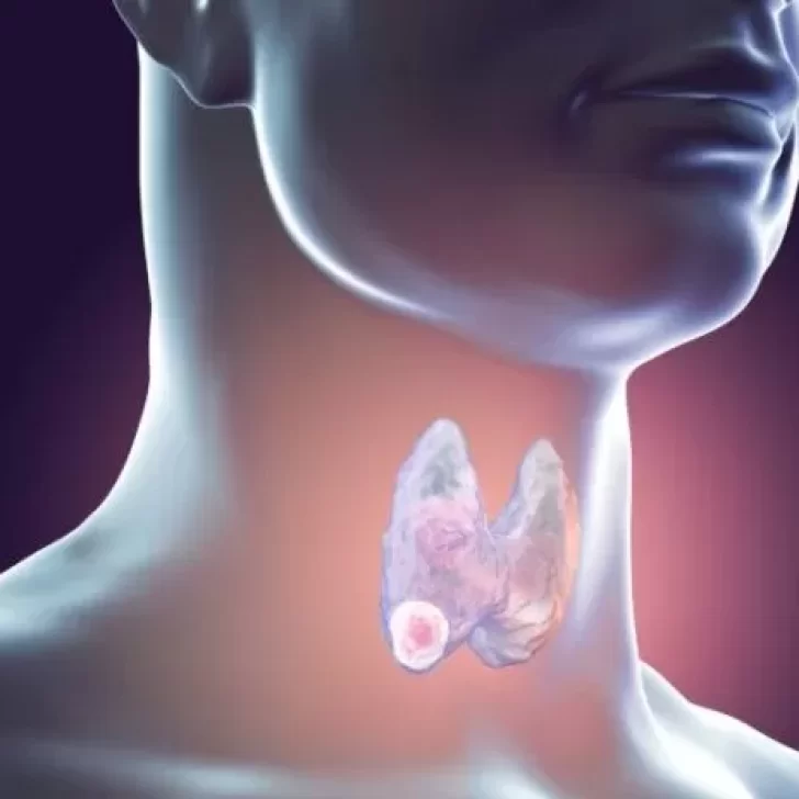 Cada dos horas, una persona es diagnosticada con cáncer de tiroides en Argentina