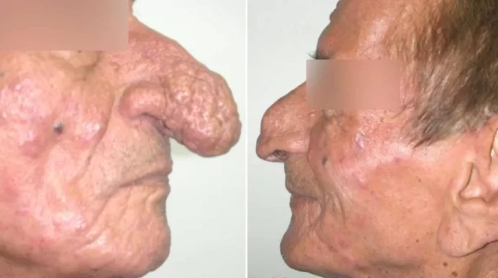La historia de “Trompita”, un argentino que tenía una nariz de 14 centímetros debido una extraña enfermedad