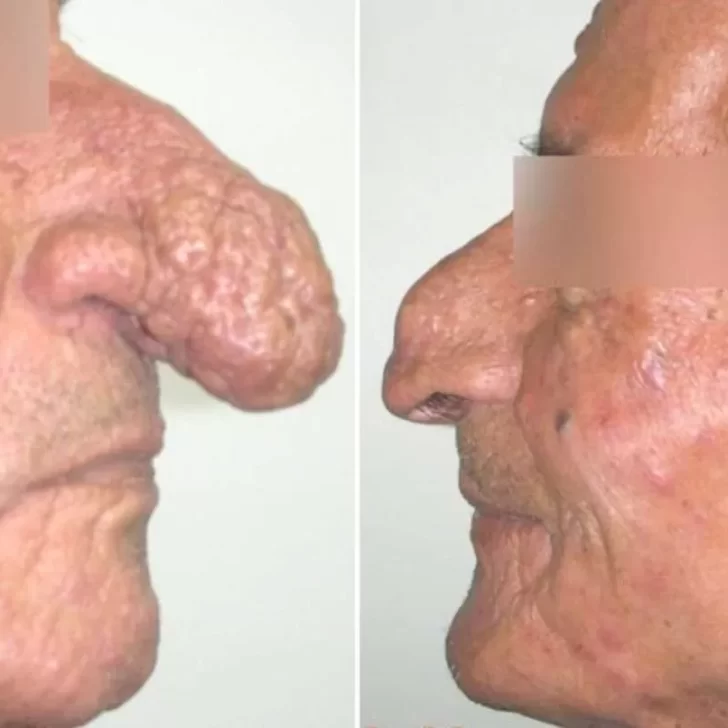 La historia de “Trompita”, un argentino que tenía una nariz de 14 centímetros debido una extraña enfermedad