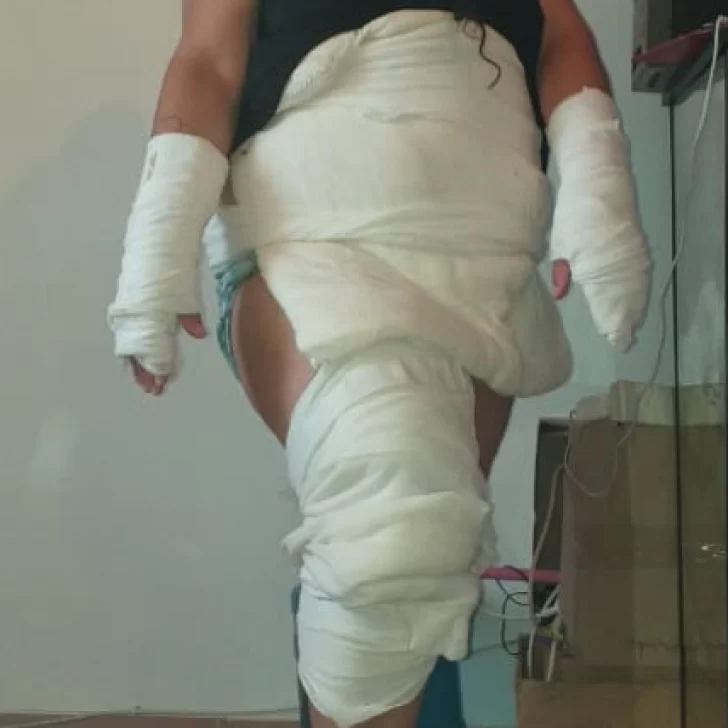 Se quemó con agua hervida y pidió ayuda a la comunidad Se quemó con agua hervida y pidió ayuda a la comunidad