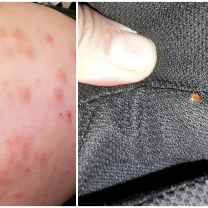 Una pasajera “escrachó” a un colectivo de larga distancia tras terminar con picaduras de chinches en todo su cuerpo Una pasajera “escrachó” a un colectivo de larga distancia tras terminar con picaduras de chinches en todo su cuerpo