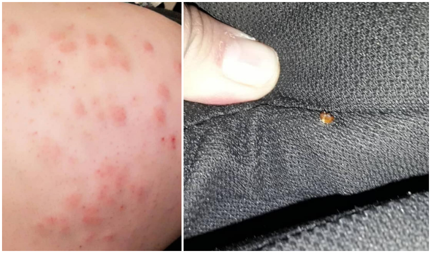 Una pasajera “escrachó” a un colectivo de larga distancia tras terminar con picaduras de chinches en todo su cuerpo Una pasajera “escrachó” a un colectivo de larga distancia tras terminar con picaduras de chinches en todo su cuerpo