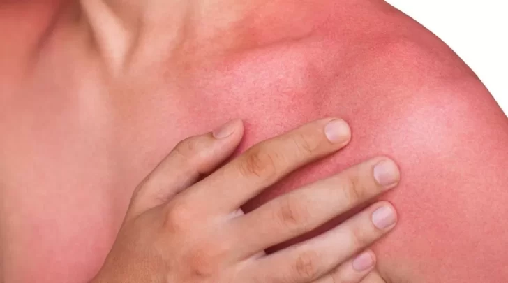 Verano 2022: cómo curar las quemaduras de sol con remedios caseros