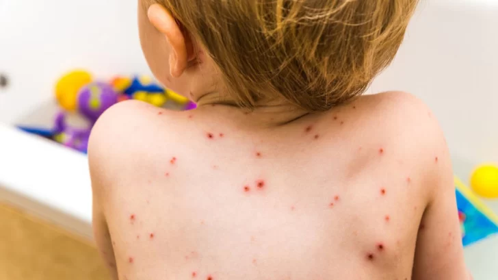 Llega la primavera… y las enfermedades  eruptivas: cómo reconocer los síntomas