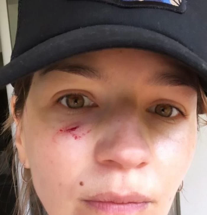 Marcela Kloosterboer sufrió un accidente doméstico y mostró su cara sangrando