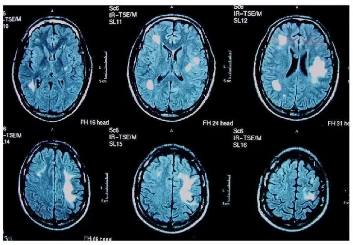 Qué es leuco encefalopatía multifocal progresiva, le enfermedad que afecta al joven Maxi Suárez