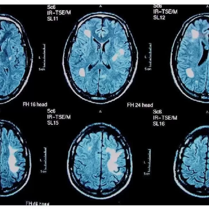 Qué es leuco encefalopatía multifocal progresiva, le enfermedad que afecta al joven Maxi Suárez