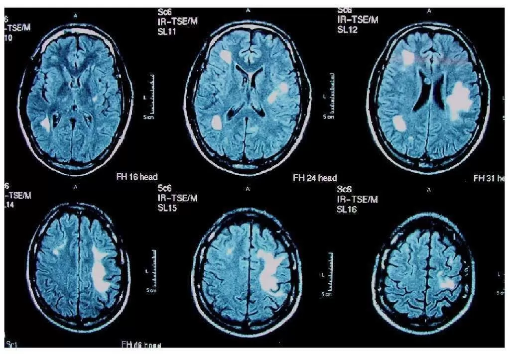 Qué es leuco encefalopatía multifocal progresiva, le enfermedad que afecta al joven Maxi Suárez