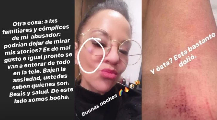 ¿Qué pasó con Miss Bolivia? Su separación, denuncia en redes y fotos de golpes