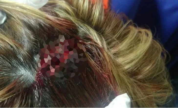 Una mujer fue atacada con una pala en la cabeza durante pelea entre vecinos