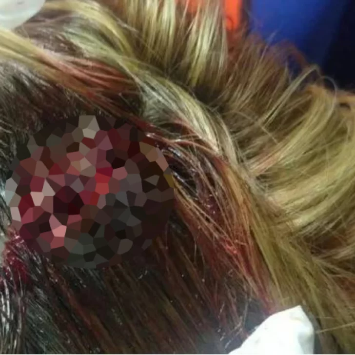 Una mujer fue atacada con una pala en la cabeza durante pelea entre vecinos