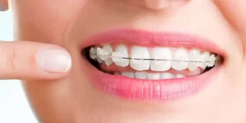 ANMAT prohibió el uso de una marca de brackets considerada ilegal: ¿Cuál es?