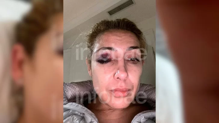 Nuevas fotos revelan golpes en el rostro de Fabiola Yañez: la ex primera dama acusa a Alberto Fernández de violencia