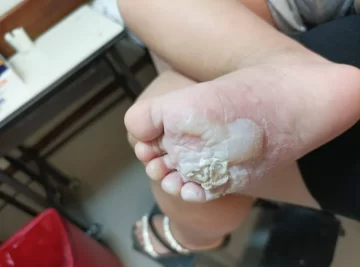 Hicieron asado en la playa y taparon las brasas con arena: un bebé pasó y se quemó el pie