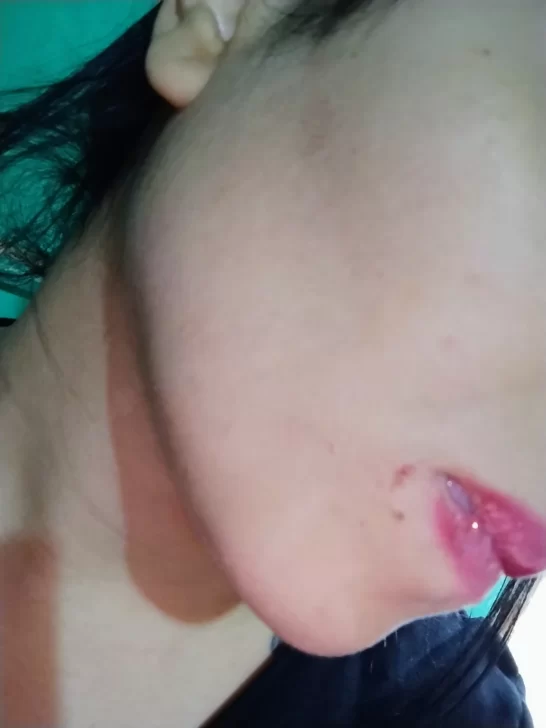  Una de las lesiones que sufrió Vanesa.