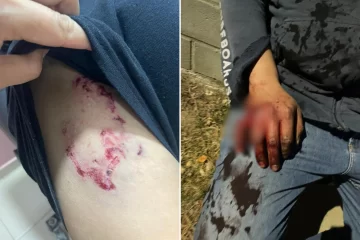 “Casi me mataron”, declaró el vecino que fue acorralado y atacado por dos perros pitbulls en Caleta Olivia