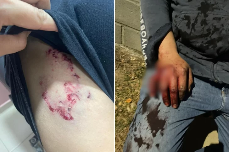 “Casi me mataron”, declaró el vecino que fue acorralado y atacado por dos perros pitbulls en Caleta Olivia