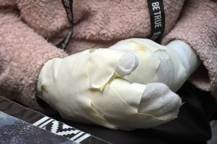  Las manos vendadas de Glenda tras el siniestro. (FOTO: JUAN PALACIOS/LA OPINIÓN AUSTRAL)