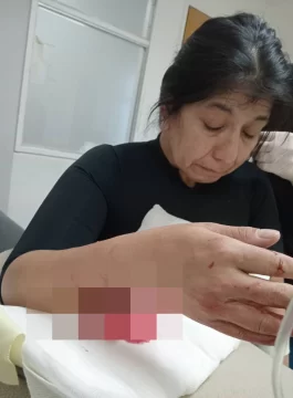 Imágenes sensibles. Salió a correr y fue atacada por un pitbull: “Le pusieron dos clavos que sostienen el tendón y el hueso” Imágenes sensibles. Salió a correr y fue atacada por un pitbull: “Le pusieron dos clavos que sostienen el tendón y el hueso”