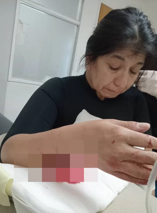  Este domingo, Viviana Velásquez fue víctima de un feroz ataque de un perro de raza pitbull.