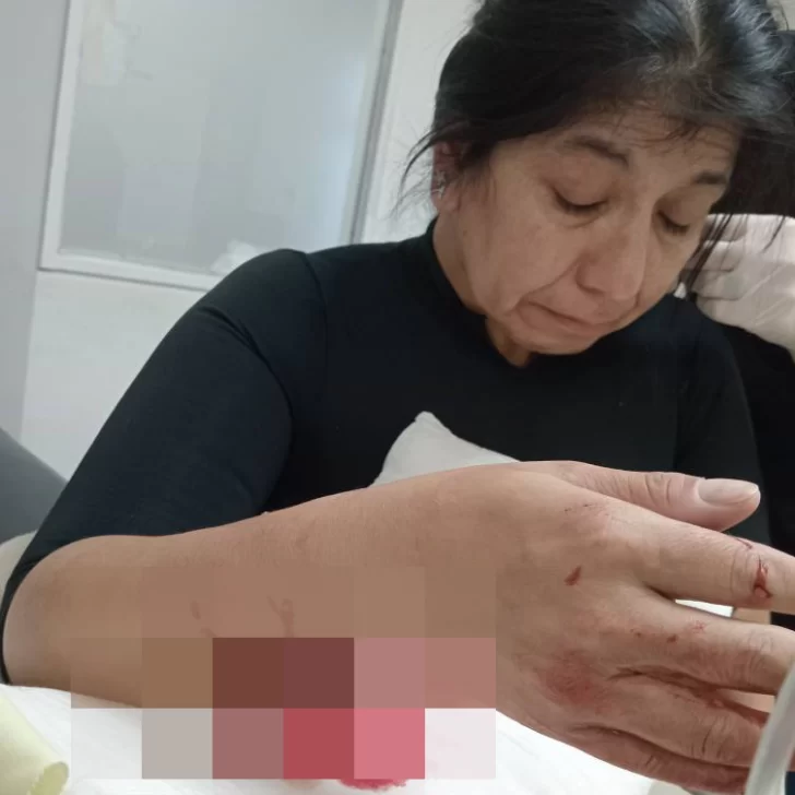 Imágenes sensibles. Salió a correr y fue atacada por un pitbull: “Le pusieron dos clavos que sostienen el tendón y el hueso” Imágenes sensibles. Salió a correr y fue atacada por un pitbull: “Le pusieron dos clavos que sostienen el tendón y el hueso”