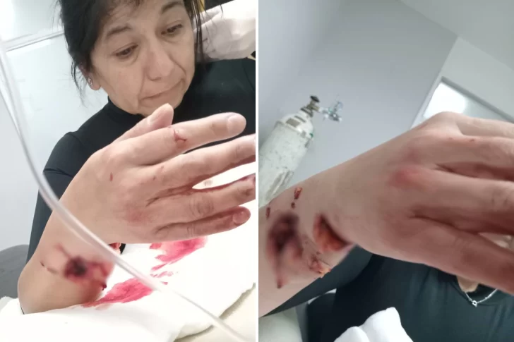 Un pitbull atacó a una runner en la costanera y terminó en el quirófano: &#8220;Le destrozó el brazo&#8221;