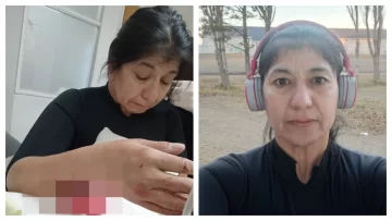 El pitbull que atacó a la runner ya había mordido a un pescador en la cara El pitbull que atacó a la runner ya había mordido a un pescador en la cara