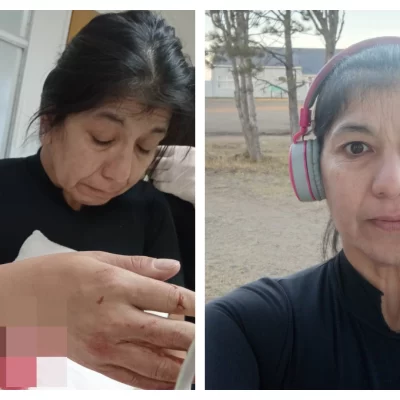 El pitbull que atacó a la runner ya había mordido a un pescador en la cara
