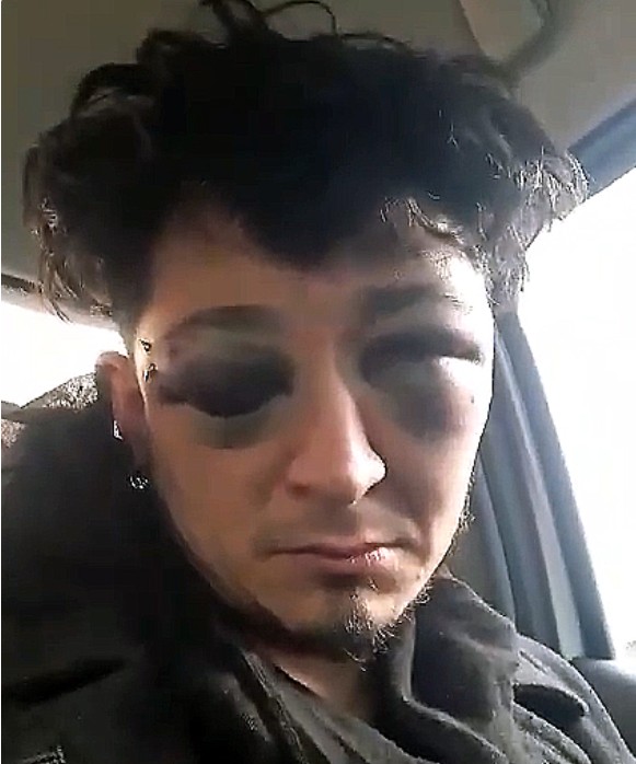 La caras desfigurada del músico Ariel Carrizo. Tiene el riesgo de perder uno de sus ojos.
