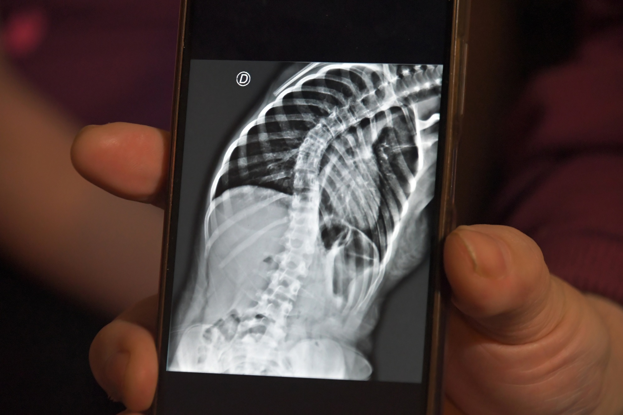  La cirugía permitirá corregir la curvatura anormal de la columna vertebral. Foto: José Silva/La Opinión Austral