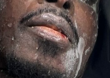  La lesión en el labio de Carlos. (FOTO: LA OPINIÓN AUSTRAL)