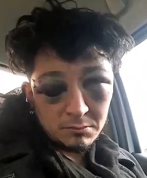 Músico evadió un control y denunció haber sido golpeado brutalmente por la Policía: “Puedo perder un ojo” Músico evadió un control y denunció haber sido golpeado brutalmente por la Policía: “Puedo perder un ojo”