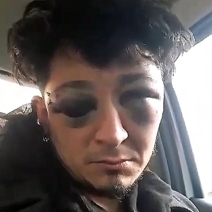 Músico evadió un control y denunció haber sido golpeado brutalmente por la Policía: “Puedo perder un ojo” Músico evadió un control y denunció haber sido golpeado brutalmente por la Policía: “Puedo perder un ojo”