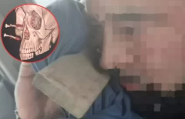 Cortaba leña y terminó con una madera y dos clavos incrustados en la cara Cortaba leña y terminó con una madera y dos clavos incrustados en la cara