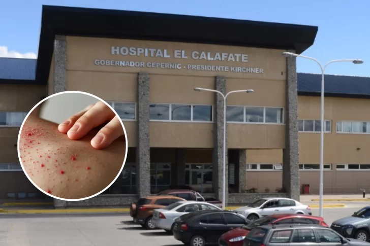 Aseguran que es poco probable un caso de sarampión en El Calafate