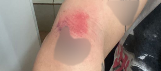  El hematoma que presentó la joven y que ella difundió en Facebook. FOTO: LA OPINIÓN AUSTRAL