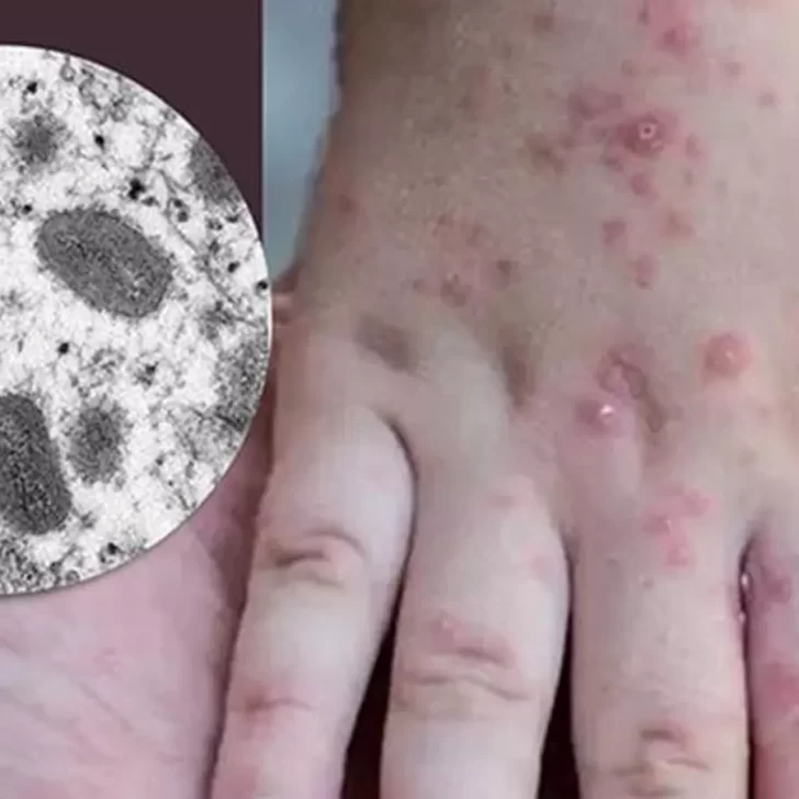 Alerta por dos casos confirmados de Viruela del Mono en Calafate y Gregores