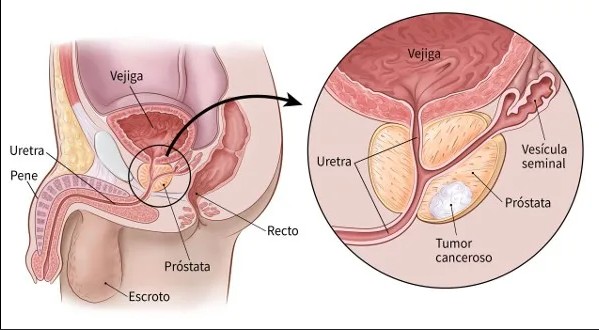  La estadística dice que si a una persona se le diagnostica un cáncer de próstata avanzado con metástasis, a los 5 años está vivo el 37%.
