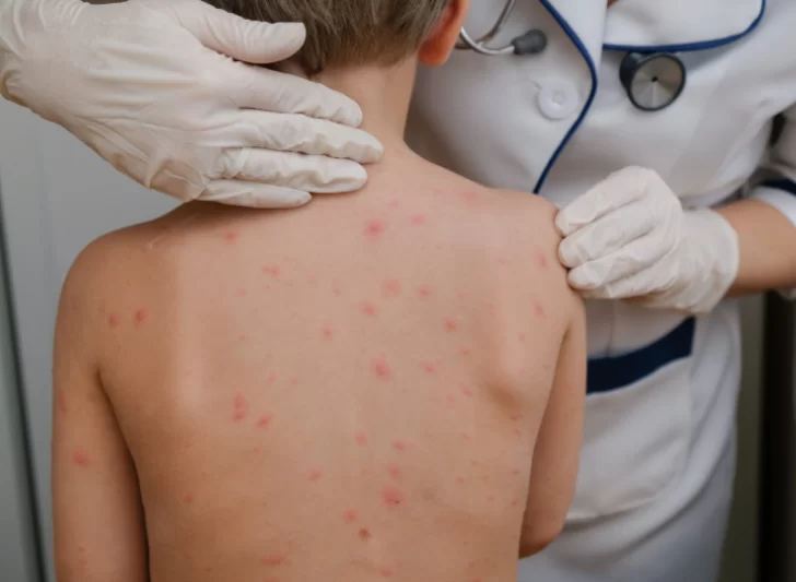 Sarampión en Argentina: hay un santacruceño entre los 98 contactos de la familia rusa que viajó infectada por el país Sarampión en Argentina: hay un santacruceño entre los 98 contactos de la familia rusa que viajó infectada por el país