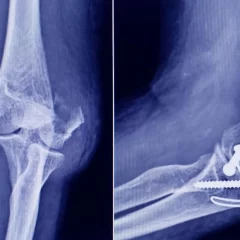 ANMAT detectó un tornillo falsificado usado en cirugías traumatológicas: qué es y cómo identificarlo